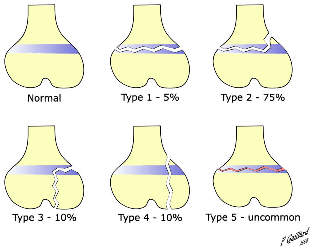 SalterHarris freq